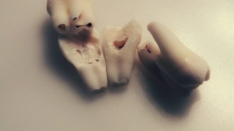 Photo dreams about teeth falling out